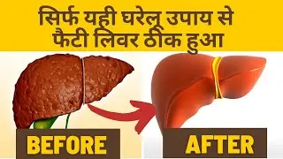 Fatty Liver Treatment | Fatty Liver Exercise | Fatty Liver Home Remedies | sgpt sgot