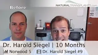 Hair Restoration 10 Month Update | Baldness Cure 2020 (Harold)