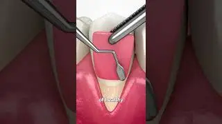 How They Fix Messed Up Gums 🦷