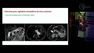 Session Atteintes pancréatiques et gastro-intestinales - Atteinte pancréatique
