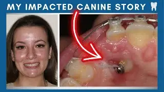 How My Impacted Canine affected My Braces Journey!