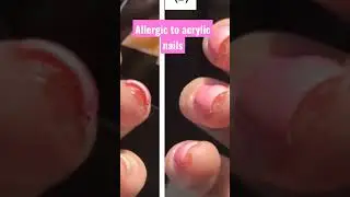 что делать, если у вас возникла аллергическая реакция 💕
