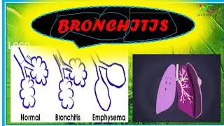 Bronchitis | Full Explanation in Hindi | By N.G. Medicals
