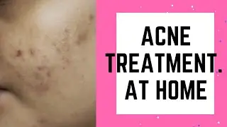 Acne treatment at home !! how to remove pimples overnight !!