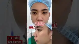 D&Aacute;NG MŨI 5 NG&Agrave;Y QU&Aacute; ĐẸP#nangmui #shorts #thammy #lamdep #drduc