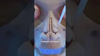 How A Nose Surgery Works 🤔
