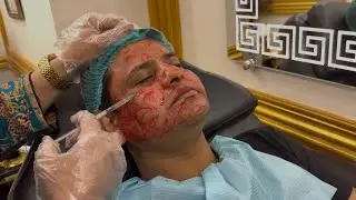 Micro Needling PRP | Mesotherapy Treatment For Face Pigmentation| First Sitting Reults