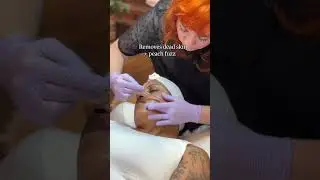 Epidermal Leveling is Everything!