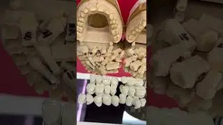 28-Unit Full Mouth Restoration!