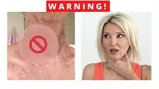 The risks of Fraxel (Fractional) Laser / Over 50