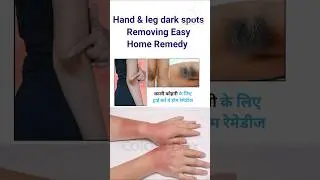 Hand & leg dark spots Removing Easy Home Remedy tips!! #diy #short #ytshorts #skincare