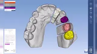 Planmeca PlanCAD Premium &ndash; Semi-Automatic tooth placement