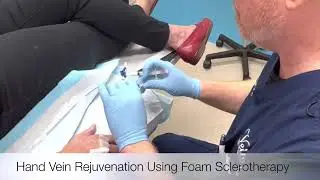 Hand Vein Rejuvenation, Non-Surgical Treatment