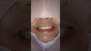 Zirconia Fixed Bridge