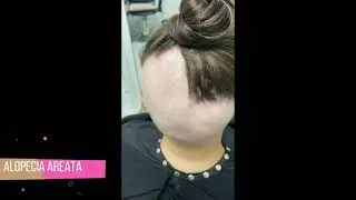 Alopecia Areata - fake skin mesh integration - hair loss