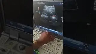 Ultrasound Imaging of the IVC