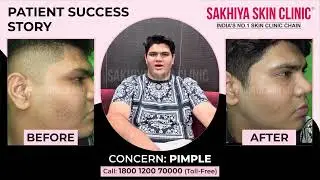 Best Acne Scar Treatment | Real Patient Success Story | Sakhiya Skin Clinic
