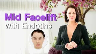 Mid Facelift with Endotine® | Minimal Invasive Facial Rejuvenation | Elena’s 6-Month Result