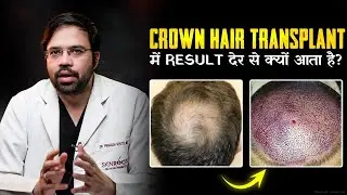 Crown Hair Transplant: Why It Takes More Time to Show Results | Dr. Prakash Khute MD (AIMS, Delhi)