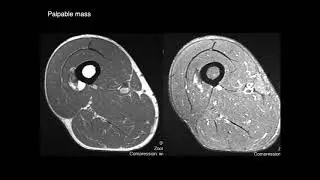 Bone Tumors Pt 3