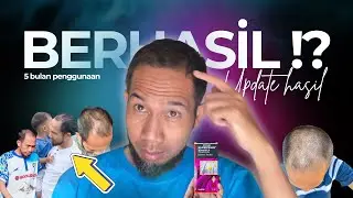UPDATE!! HASIL PENGGUNAAN SANBE HAIR 5 BULAN PEMAKAIAN