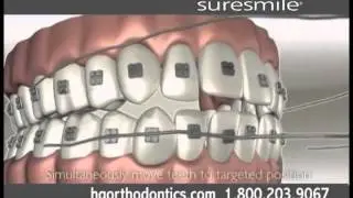 HG Orthodontics - Sure Smile