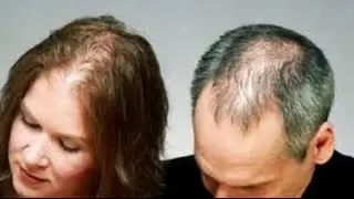 calvicie (alopecia)hombre y mujer👧🙋remdio natural .👌