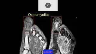 MRI of the Ankle, Part 16 &ndash; Ankle Infections