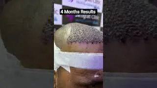 4 Months Results amazing Hair Transplant Surgery #hairfalltreatment #prphairtreatment #hair