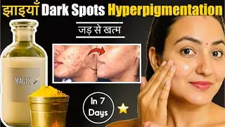 7 Days Skin Challenge : Remove Dark Spots, Acne Scars, Pimple Marks & Pigmentation | 100% Results💕