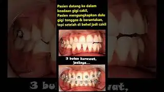 3 bulan merawat behel gigi cakil yang awalnya gigi tonggos, dokter gigi jogja menjelaskan