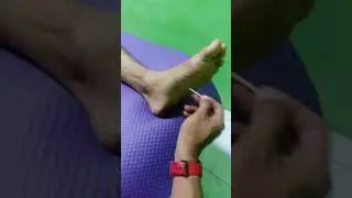 cheking telapak kaki akibat cedera dengan tusuk gigi