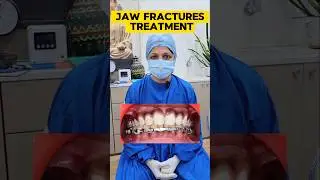 Lower jaw fractures broken | निचले जबड़े के फ्रैक्चर की मरम्मत #jawfracture #dentist #drneetuagarwal