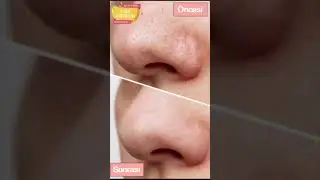 MİLAND Vakumlu Cilt G&ouml;zenek Siyah Nokta Akne Sivilce Temizleyici