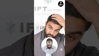 Best Hair Transplant In Alwar: Real Truth | IFT Hair Science