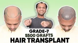 Best Hair Transplant in Hyderabad (HX-MNAO) | Best Results & Cost of Hair Transplant in Hyderabad
