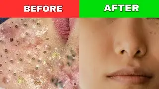 This Life Hack Cleared My Acne | Say Goodbye to Acne Forever! #skincare #acne #acnetreatment