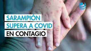 &iquest;El sarampi&oacute;n es m&aacute;s contagioso que la COVID-19? Esto dicen en la UNAM