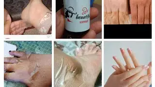 طريقه استخدام مقشر احماض الفواكه بالتفضيل (تجربتي مع تقشير الرجل من اول يوم لاخر يوم )