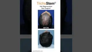 Pattern Hair Loss - Maximizing Hair Growth and Thickness #hairlosstreatment