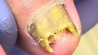 Extremely Curly And Growing Nails, Infected By Onychomycosis Bacteria【Dr. Liu's Pedicur】