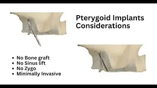 Pterygoid Surgical Considerations Deep Dive with experts