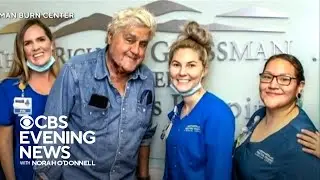 Jay Leno released from burn center