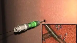 Bile Ducts & Duodenum--NK2 KIT-Using Metal Stiffening Cannula Method.mpe