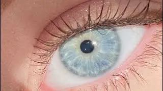 iris lightening + A10 blue eyes