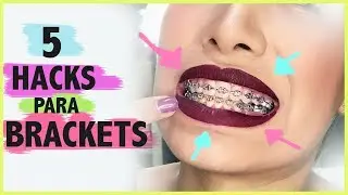 5 HACKS PARA QUIENES TIENEN BRACKETS!! Carel Quezada