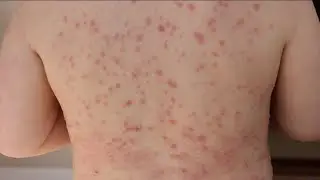 School districts across Carolinas monitor measles outbreak