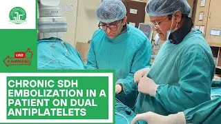 Middle Meningeal Artery Embolization for Chronic SDH Post-Carotid Stenting | IRFACILITIES