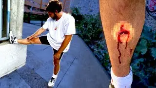 ME REVENTÉ LA TIBIA…💥(puntos incluidos)