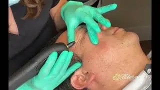 Plasma Fibroblast Therapy (Plasma IQ)